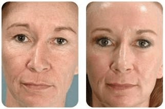 Resultado antes e depois Firmage - Caso 3