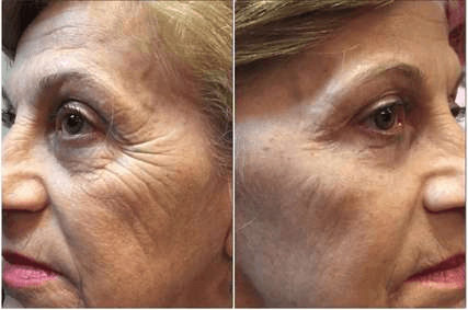 Resultado antes e depois Firmage - Caso 4